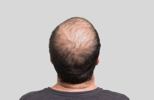 Cientistas anunciam fórmula que faz o cabelo “renascer” em 20 dias e reacende debate sobre o fim da calvície