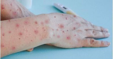 Sesab descarta existência de Mpox no estado após investigação de casos suspeitos