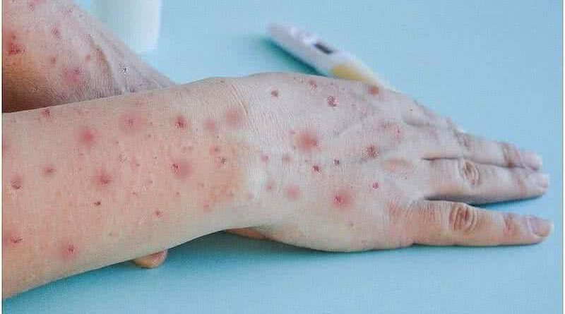 Sesab descarta existência de Mpox no estado após investigação de casos suspeitos